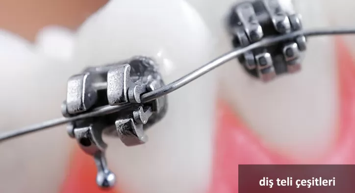 Diş Teli Çeşitleri ve Farkları