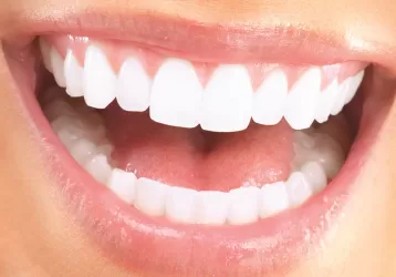 Lamina Porselen Kaplama