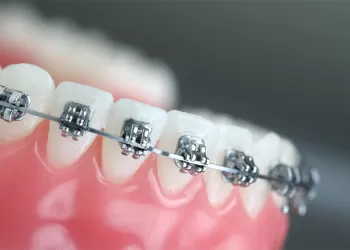 Düzeltici Ortodonti