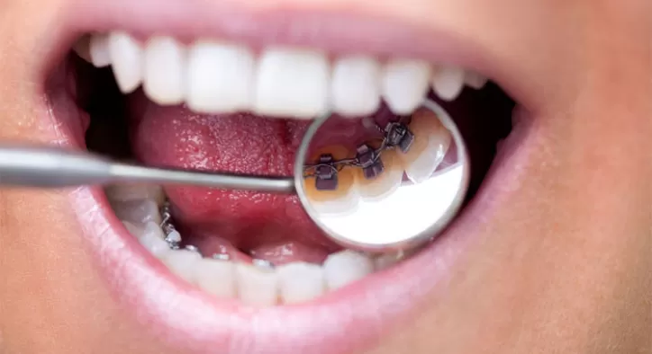 Ortodontik Problemler Nelerdir?