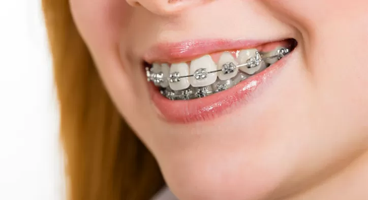 Ortodontik Tedavi Sonuçlandırma