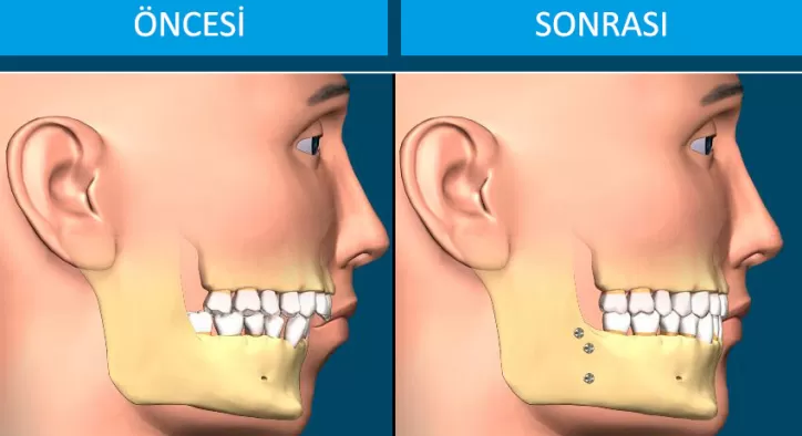Ortognatik Ortodonti