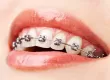 Sabit Ortodonti