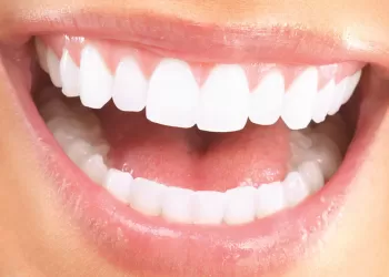 Lamina Porselen Kaplama